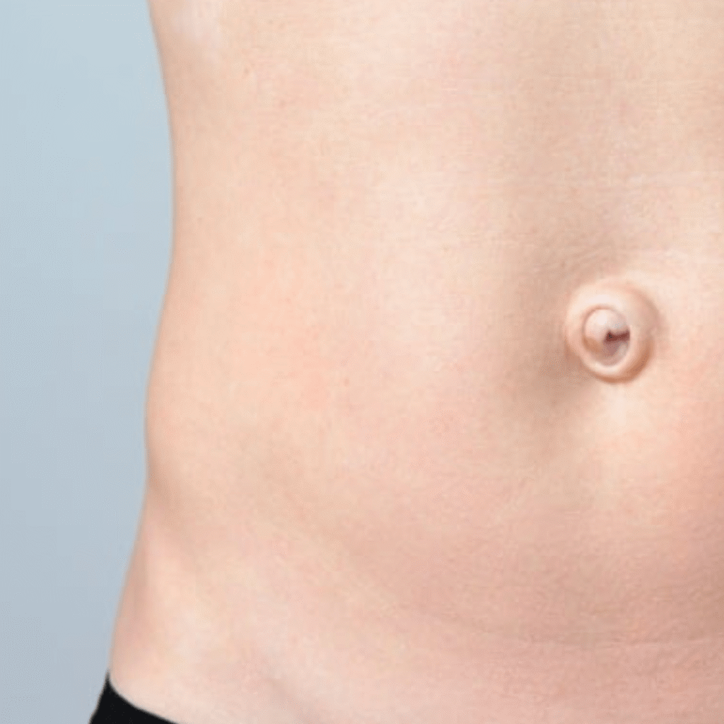 Hernia umbilical