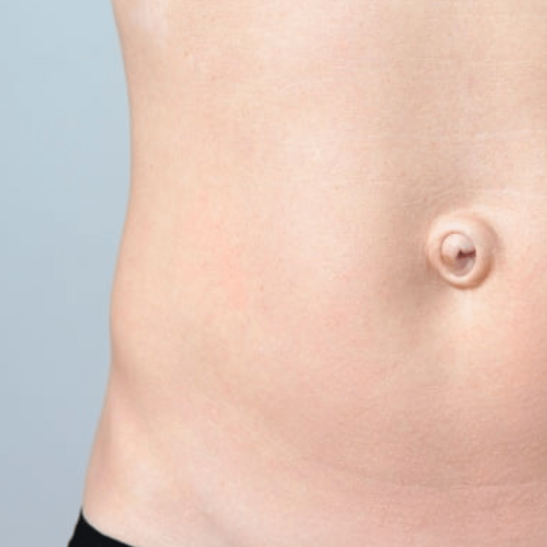Hernia umbilical